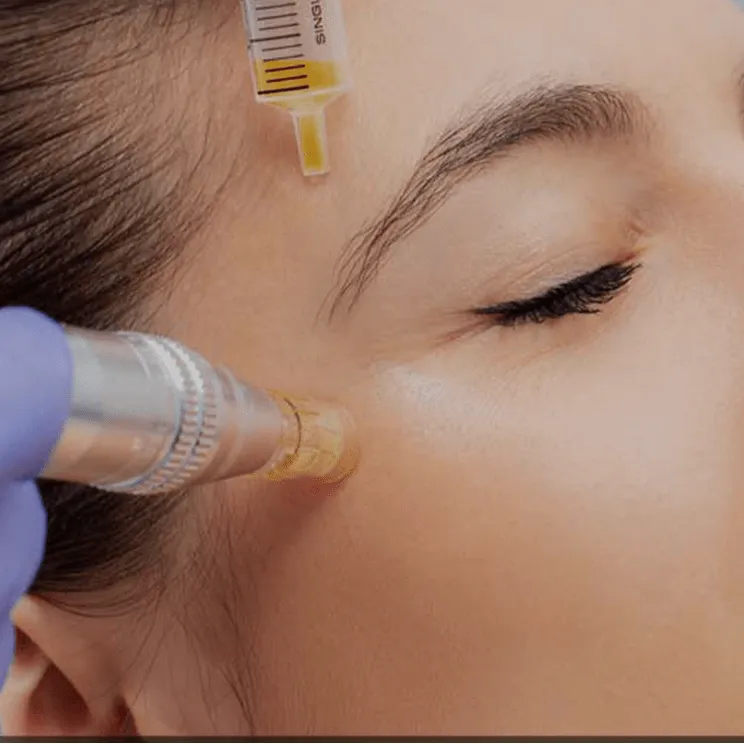 PRP Microneedling | SE Suite E NM | Isla Aesthetics